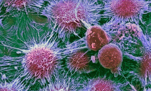 Imagen: Microfotografía electrónica de barrido (SEM) a color de células de cáncer (rosadas) de un tumor renal (Fotografía cortesía de David McCarthy / SPL).